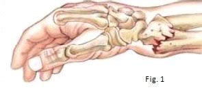 Fractura de muñeca causas y tratamiento Camde