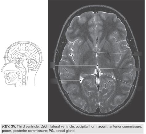 MRI Brain Anatomy Axial 4 Diagram | Quizlet