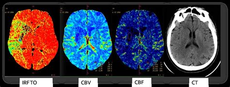 Ct Perfusion Imaging Patient 65 Years Male 2 Hours From Onset Left