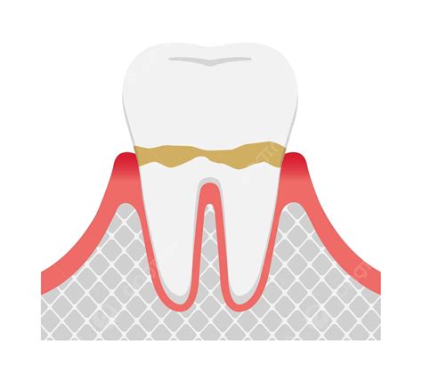 The Stages Of Periodontitis Diseasegingivitis Dental Periodontal