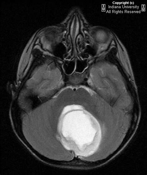 Neuroradiology On the Net: Pilocytic astrocytoma