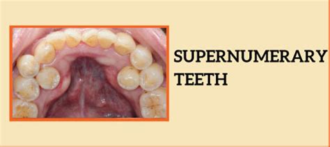 Supernumerary Teeth - Symptoms, Causes, Treatment