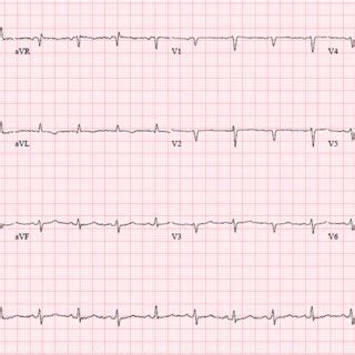 EKG showing electrical alternans in a 48-year-old patient with ...