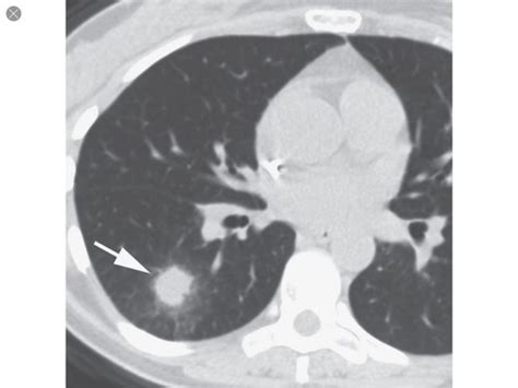 Cam I Pulmonology Malignancy Lecture Flashcards Quizlet