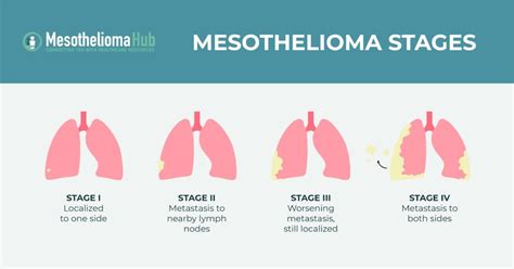 Mesothelioma 4 Stages Guide - Symptoms & Treatment