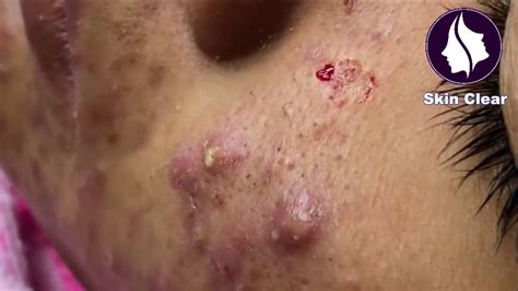 Blackheads Removal Best Pimple Popping 18 Youtube