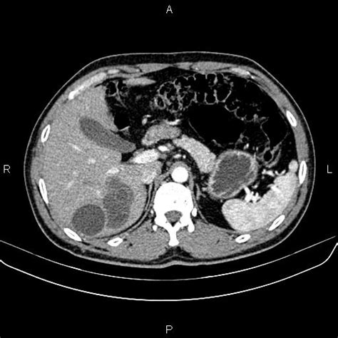 Hepatic Hydatid Cysts Image Radiopaedia Org