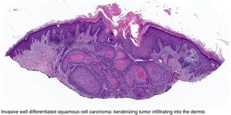 Squamous Cell Carcinoma Skin Histology