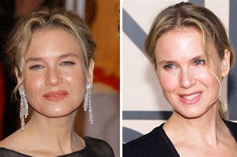 Renee Zellweger Surgery Before And After