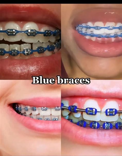 Best Color For Your Braces🦷 In 2024 Dental Braces Colors Cute Braces