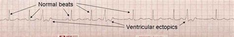 Atrial And Ventricular Ectopy