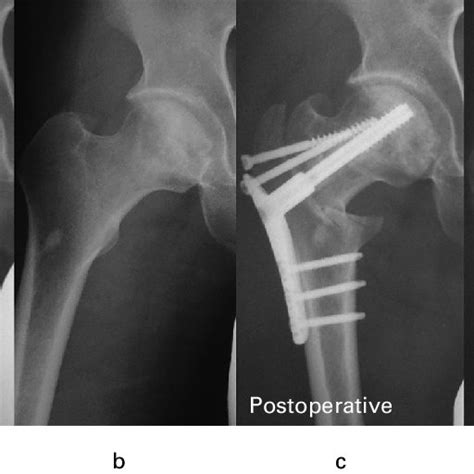 A Preoperative Anteroposterior Ap Radiograph Showing The Right Hip Download Scientific