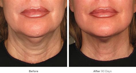 Ultherapy Neck Treatments Ultherapy For Neck NYC Smooth Synergy