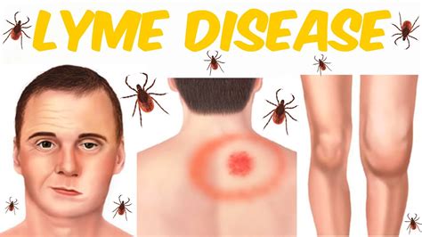 Lyme Disease ‎lyme Borreliosis Youtube