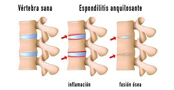 Espondilitis Anquilosante S Ntomas Causas Diagn Stico Y Tratamiento