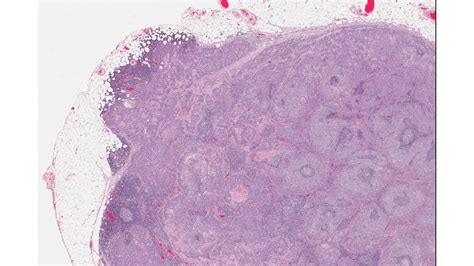 Low Power Image Of A Lymph Node Containing Metastatic Squamous Cell Download Scientific Diagram