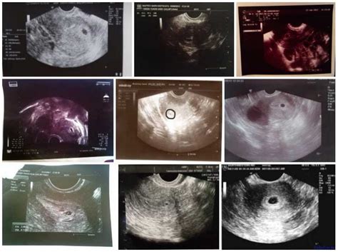 Semana 4 De Embarazo Síntomas Panza Desarrollo Fetal Y Ecografía