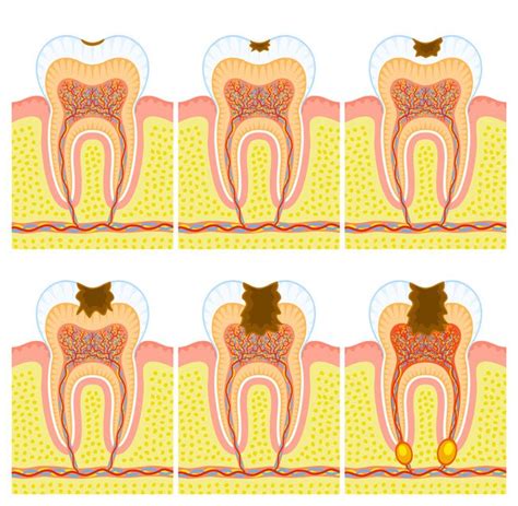 Caries Interdentales Qu Son Tratamiento Y C Mo Detectarlas Axioma