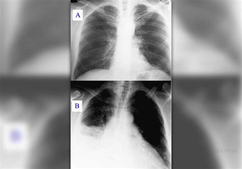 Viral pneumonia facts | General center | SteadyHealth.com