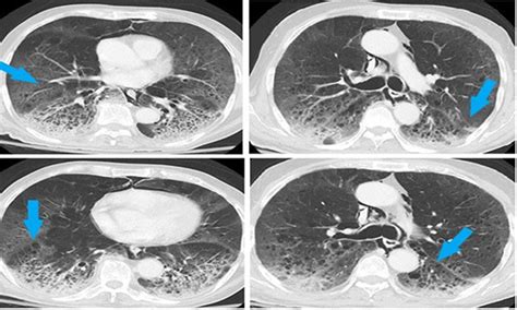 Subcutaneous Emphysema And Pneumomediastinum In Patients With Covid 19