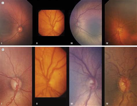 Plus Disease In Retinopathy Of Prematurity Quantitative Analysis Of