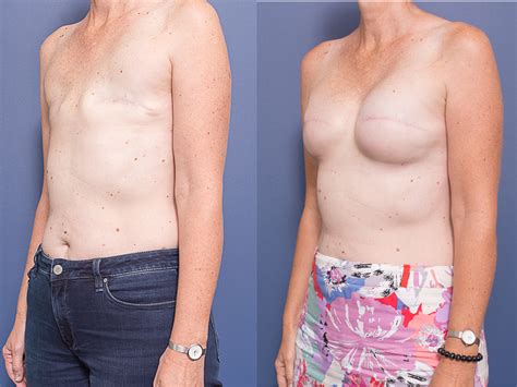 Breast Cancer Patients Wanting Breast Reconstruction Plastic Surgery