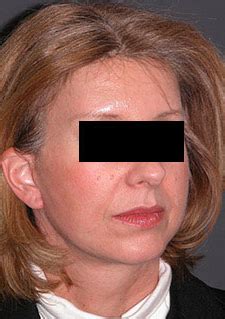 Facelift And Necklift Prof Panayiotis Kyzas