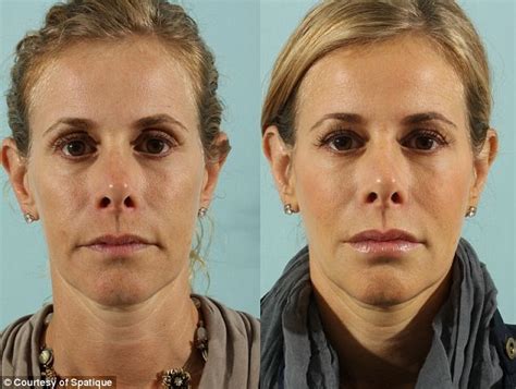 New Baby Face Fillers Can Fight The Signs Of Aging By Giving Fuller