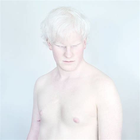 Albinism nude 62 фото