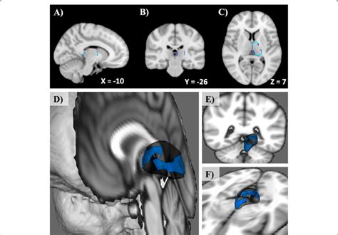 Pre Operative Contralateral Thalamus Shape Differences Between