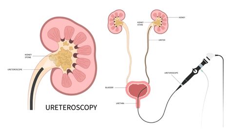 Ureteroscopy And Laser Lithotripsy Treatment Singapore Dr Fiona