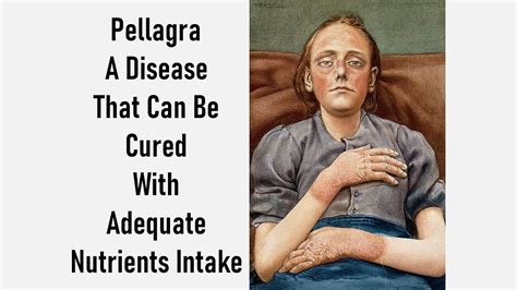 Pellagra A Disease Caused By Vitamin B3 And Or Tryptophan Deficiency