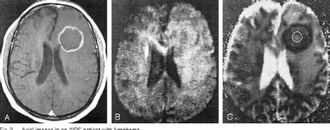 Figure 3 From Apparent Diffusion Coefficients Lymphoma In AIDS Patients