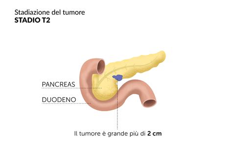 Stadi tumore pancreas classificazione operabilità metastasi