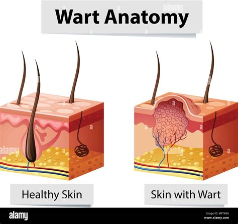 Pulled Out Plantar Wart Root Diagram