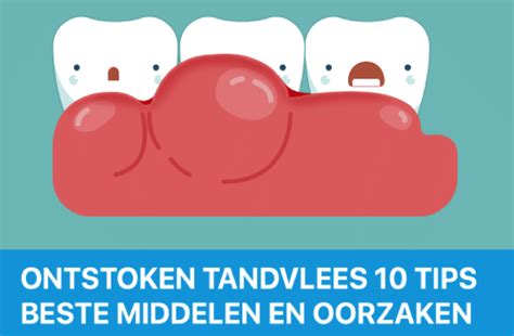 Ontstoken Tandvlees 10 Tips Middelen En Behandeling Ontstoken