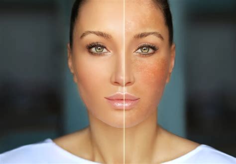 Uneven Skin Tone Understanding Its Causes Treatment