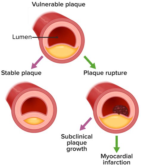 Acute Coronary Syndrome Myocardial Infarction And Unstable Angina