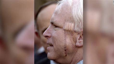 Sen John Mccain Has Brain Cancer Aggressive Tumor Surgically Removed