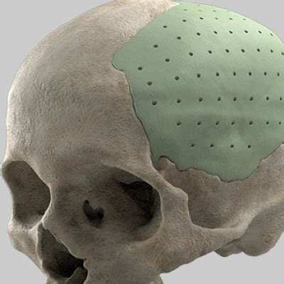 Plano de saúde deve custear cirurgia de cranioplastia prótese