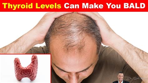 Thyroid And Hair Loss Galhairs