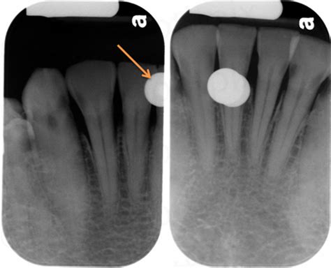 Periodontal Radiographic Assessment Normal Appearances Dr Gs Toothpix