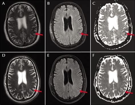 JLE Epileptic Disorders Location Atypical Lesions In Non Ketotic