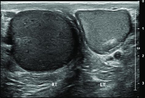 Scrotal Ultrasound Revealing Larger Volume Of The Right Testicle