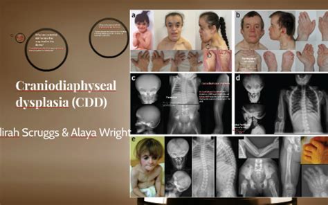 Craniodiaphyseal Dysplasia Victim