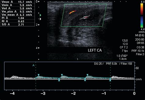 Penile Doppler Ultrasound For Erectile Dysfunction Technique And