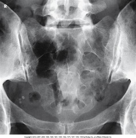 Sacrum Coccyx Projections Flashcards Quizlet