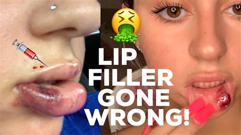 Lip Filler Gone Wrong Youtube