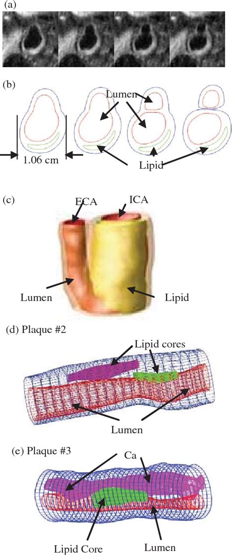 Figure 1 From In Vivo Ex Vivo MRI Based 3D Non Newtonian FSI Models For