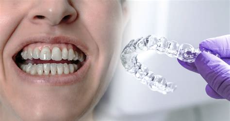 Invisalign Attachments What Are They And How Do They Work